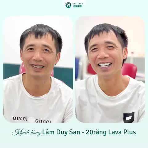 Nhiễm kháng sinh răng sẽ tối màu từ bên trong mô răng, vì thế làm mất thẩm mỹ cho người bệnh.